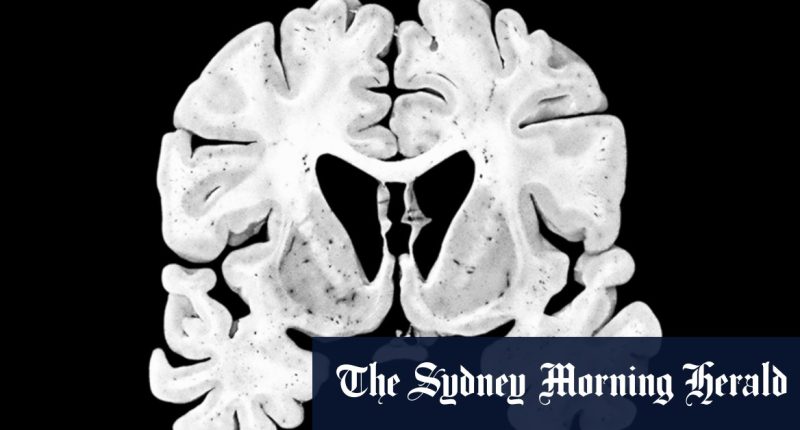 Alzheimer’s, Lewy Body dementia markers found in former rugby league, union players