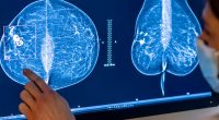 In Reversal, Expert Panel Recommends Breast Cancer Screening at 40