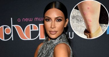 Kim Kardashian Psoriasis Pictures: Photos of Skin Breakouts