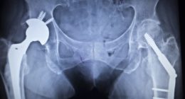 Privately funded hip replacements surge as patients shun NHS backlogs, study shows