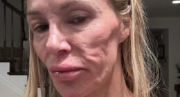 Botched surgeon issues urgent warning to Brandi Glanville and shares new theory about her 'parasite' face