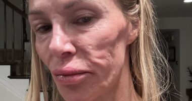 Botched surgeon issues urgent warning to Brandi Glanville and shares new theory about her 'parasite' face