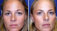 One identical twin, 38, had Botox for 20 years - the other didn't. Who looks better?