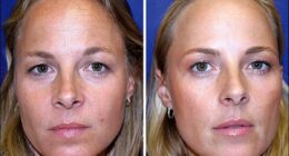 One identical twin, 38, had Botox for 20 years - the other didn't. Who looks better?