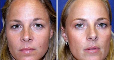 One identical twin, 38, had Botox for 20 years - the other didn't. Who looks better?