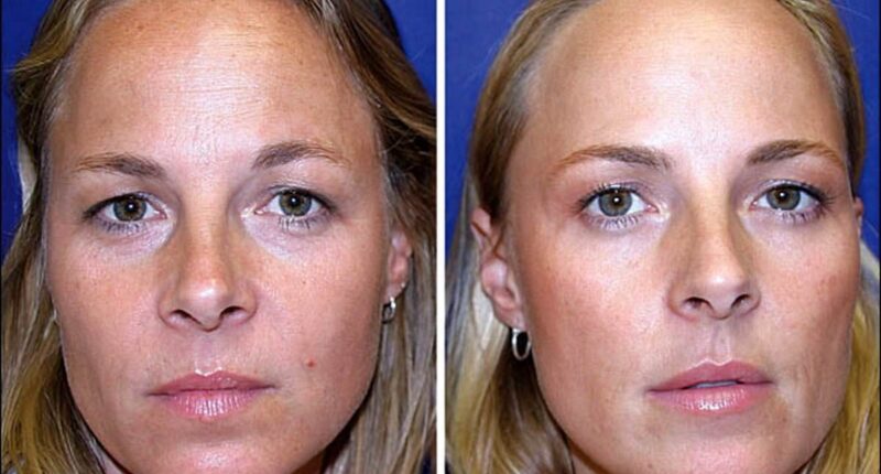 One identical twin, 38, had Botox for 20 years - the other didn't. Who looks better?