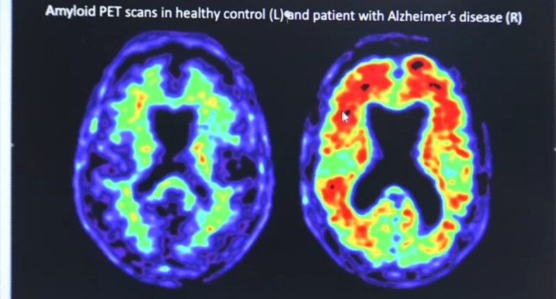 Up to 4 in 10 people could develop dementia after 55. What you can do to lower your risk