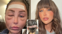 MAFS star Ella Morgan shows fans the aftermath of hair transplant surgery