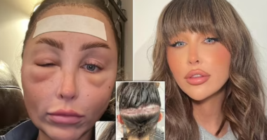 MAFS star Ella Morgan shows fans the aftermath of hair transplant surgery