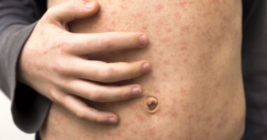 Measles outbreak continues in Texas, cases double: investigation underway