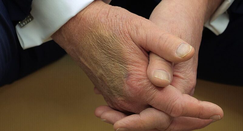 Social media speculates on what caused bruise on Trump's hand after President's three awkward handshakes with France's Macron went viral