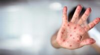 Ohio Department of Health confirms state's first measles case of 2025