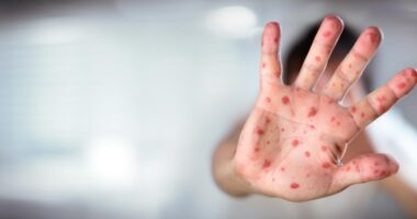 Ohio Department of Health confirms state's first measles case of 2025