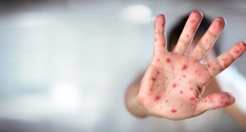 Ohio Department of Health confirms state's first measles case of 2025