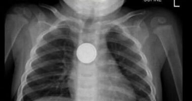 Australian medical professionals have issued an urgent warning to parents following a sharp rise in the number of young children swallowing button batteries.