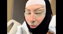 Mother's £5,500 Turkey facelift sparks concern as 'scary' videos show extreme bruising and swelling around 58-year-old's eyes after six-hour surgery