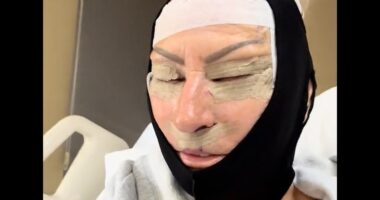 Mother's £5,500 Turkey facelift sparks concern as 'scary' videos show extreme bruising and swelling around 58-year-old's eyes after six-hour surgery