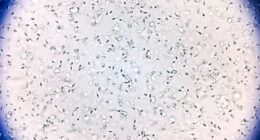 Sperm from the donor was used to conceive at least 67 children from 46 families.