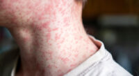US airport ranked among busiest in world is put on red alert after 3 passengers catch Earth’s most infectious disease