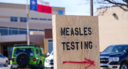 US measles case count climbs slightly to 1,046 cases, while Indiana's outbreak ends, CDC says