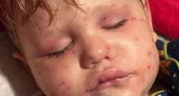 Boy, 2, born with one kidney fights for life after being stung 150 times by wasps when he bumped into nest on toy car