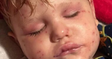 Boy, 2, born with one kidney fights for life after being stung 150 times by wasps when he bumped into nest on toy car