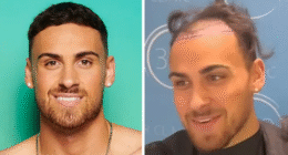 Love Island's Ben Transformation After His £3000 Hair Transplant
