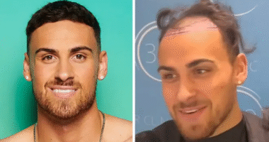Love Island's Ben Transformation After His £3000 Hair Transplant