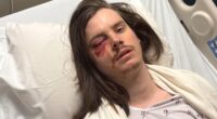Protester Marshall Woodruff shot in the eye with rubber bullet during 'No Kings Day' rally in downtown Los Angeles Saturday