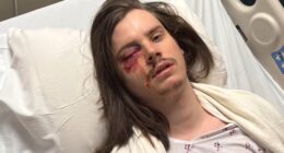Protester Marshall Woodruff shot in the eye with rubber bullet during 'No Kings Day' rally in downtown Los Angeles Saturday