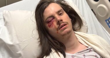 Protester Marshall Woodruff shot in the eye with rubber bullet during 'No Kings Day' rally in downtown Los Angeles Saturday