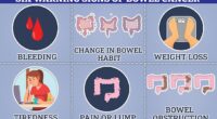 Bowel cancer can cause blood in the stool, changes in bowel habits and unexplained weight loss